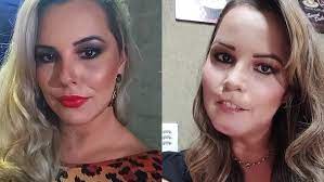 Mulher sofre consequências trágicas após procedimento estético: Perda do lábio superior