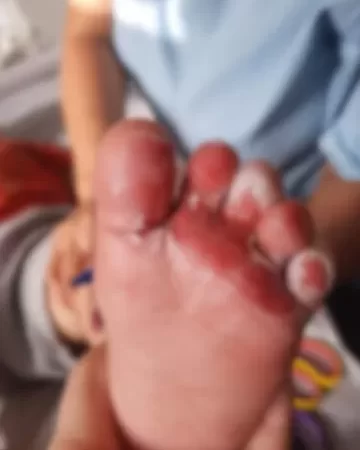Bebê sofre queimaduras durante banho em creche