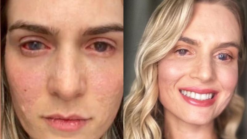 Mulher fica cega após tomar ibuprofeno para aliviar cólicas