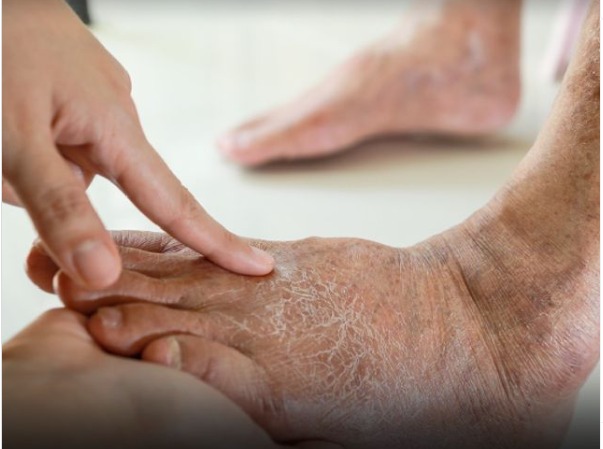 Gel cicatrizante á base de gengibre-amargo pode proteger pessoas com diabetes contra amputação