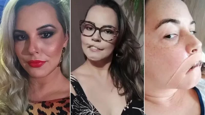 Após dois anos, cirurgião ainda encontra PMMA em influencer que perdeu o lábio devido à harmonização