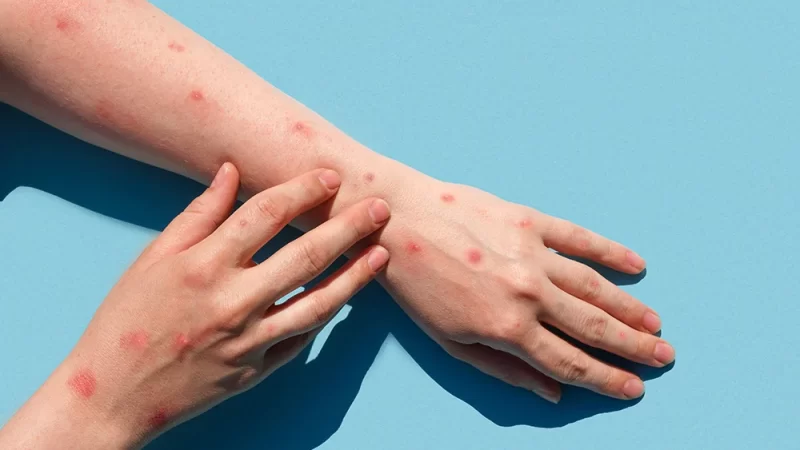 Mpox: como a doença é transmitida e como é feita a prevenção?