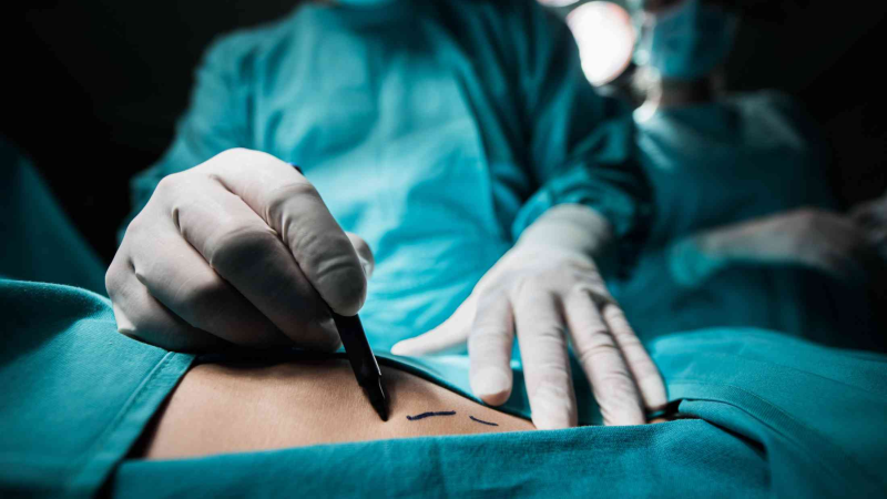 STJ obriga plano de saúde a cobrir emergência decorrente de cirurgia plástica eletiva